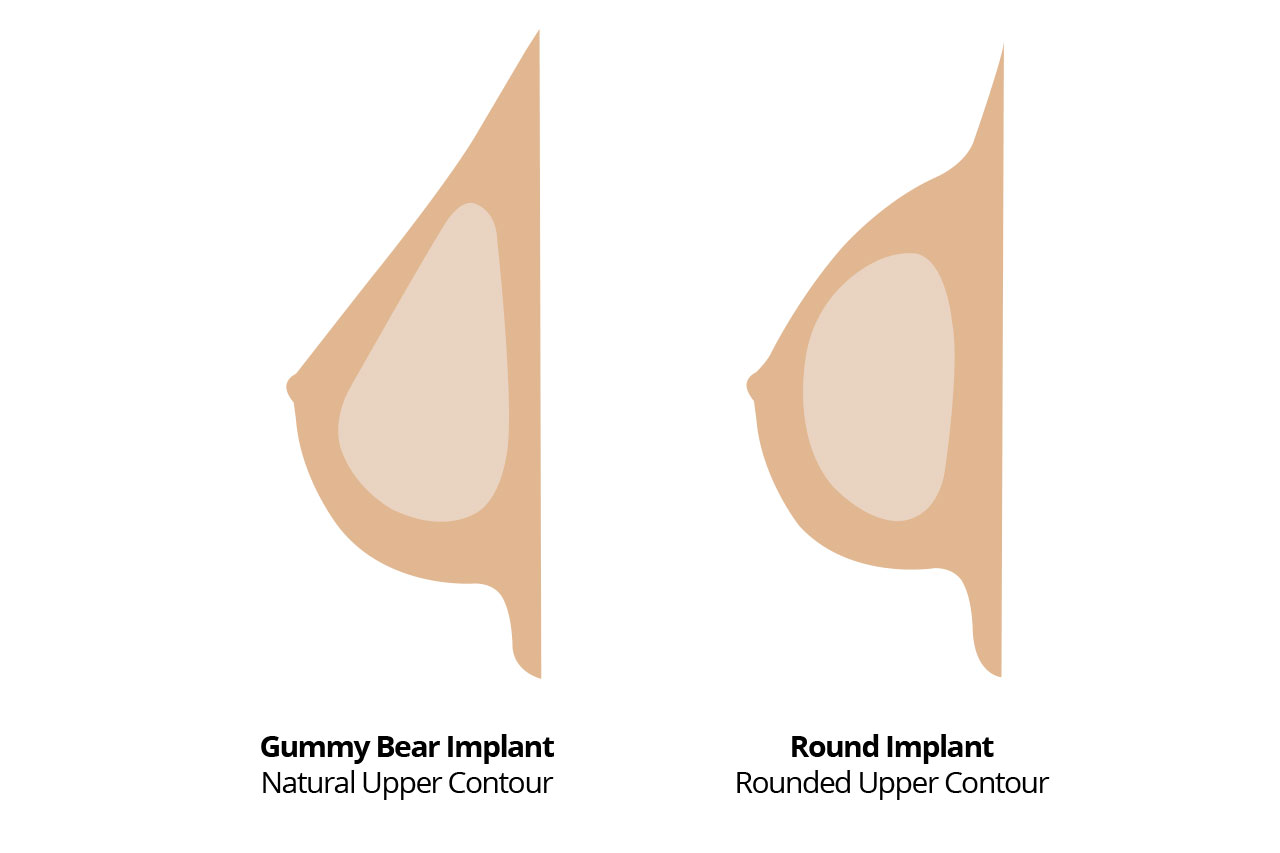 Gummy Bear vs Round Implant Shape